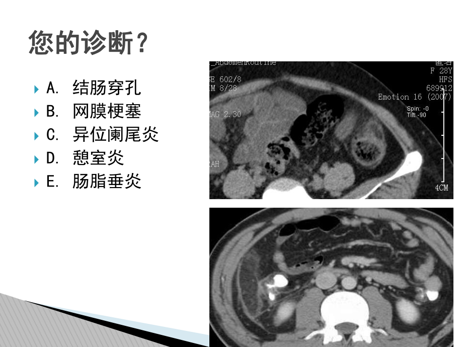 腹腔炎性脂肪性肿块和鉴别诊断课件.ppt_第3页