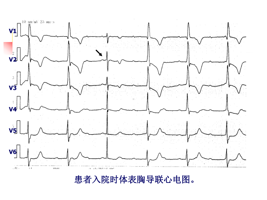 高AVB植入双腔起搏器术后VCM运作课件.pptx_第3页