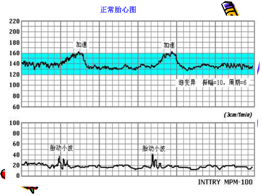 胎心监护课件解答.ppt_第3页