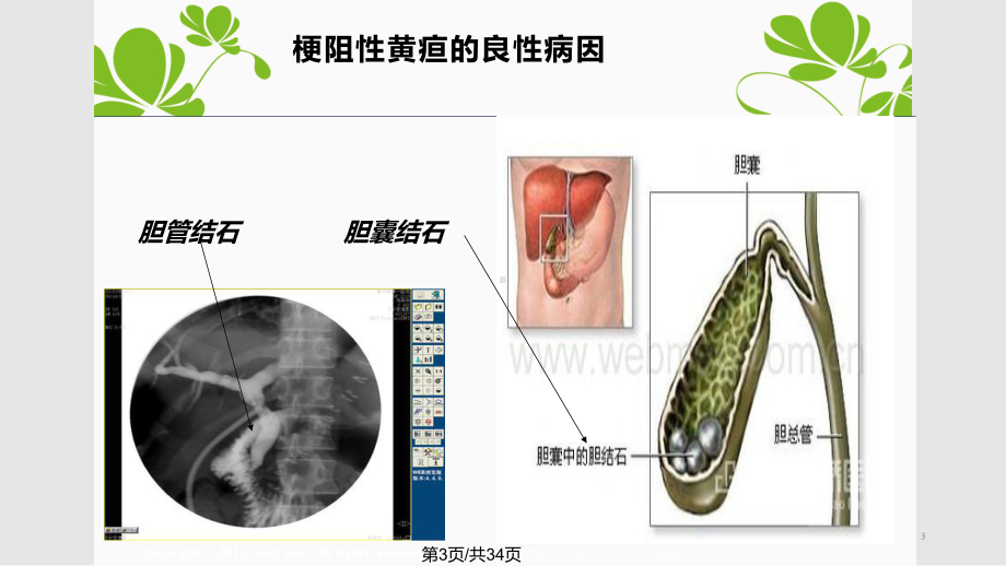 梗阻性黄疸护理课件.pptx_第3页