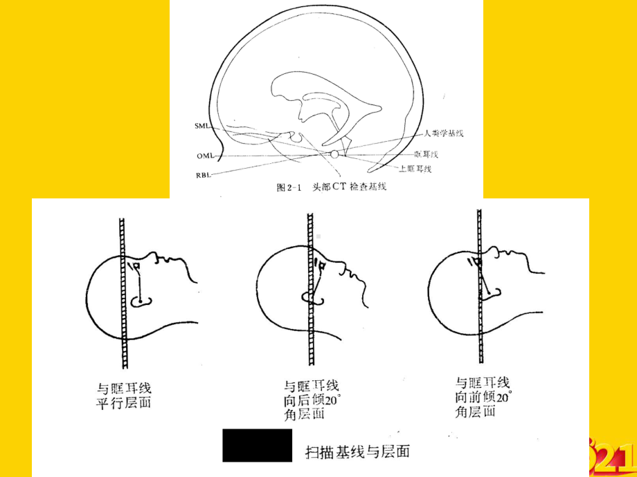 颅脑CT读片技能培训正式完整版课件.ppt_第3页