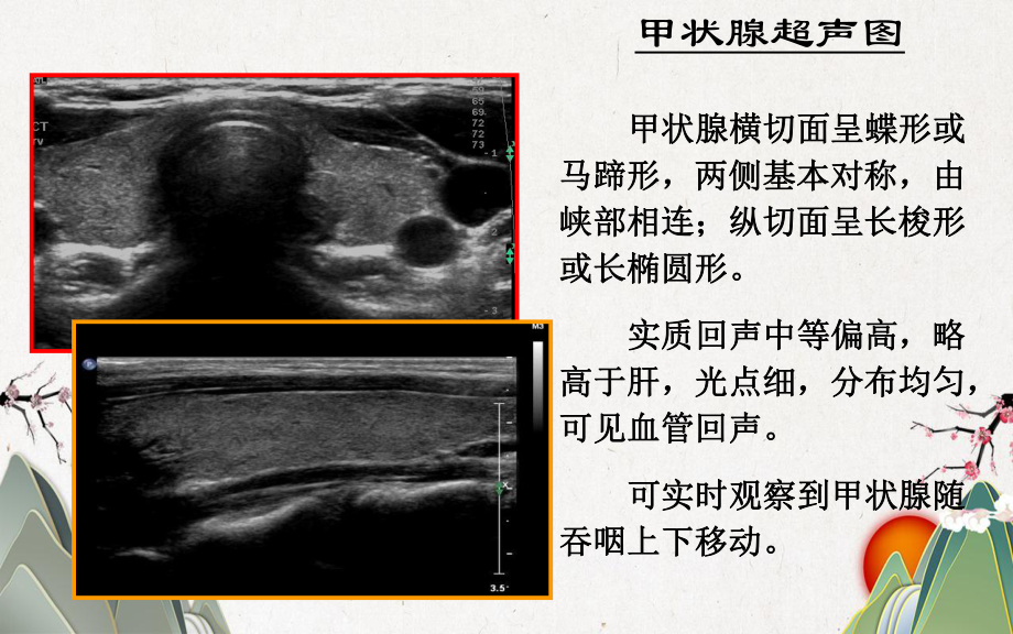 甲状腺的超声解读课件.pptx_第3页