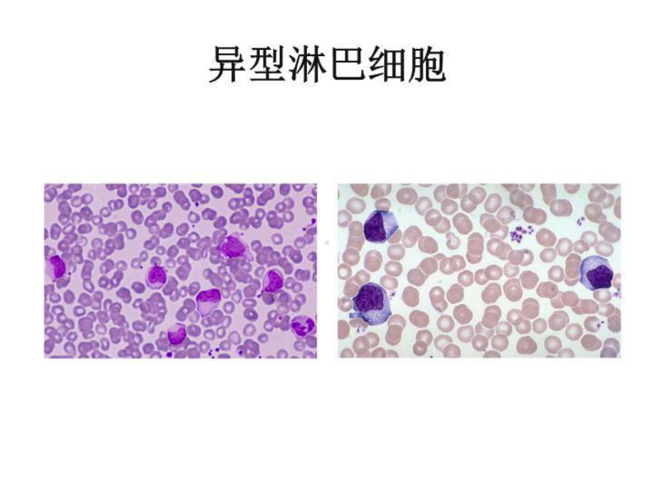 白血病图谱课件.ppt_第3页