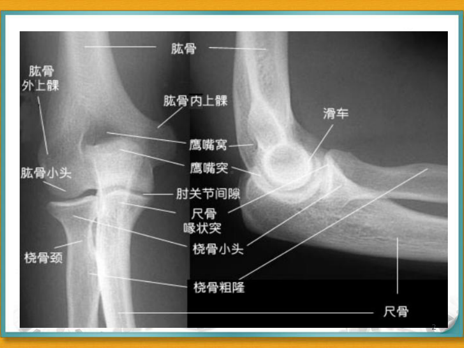 肘关节脱位课件.ppt_第2页