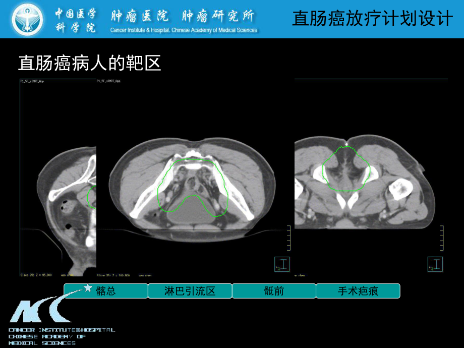 盆腔放射治疗计划—直肠癌放疗计划的设计共30张课件.ppt_第3页