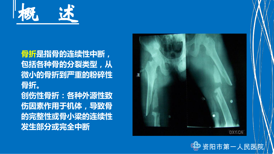 骨折急救基础知识讲座课件.ppt_第2页