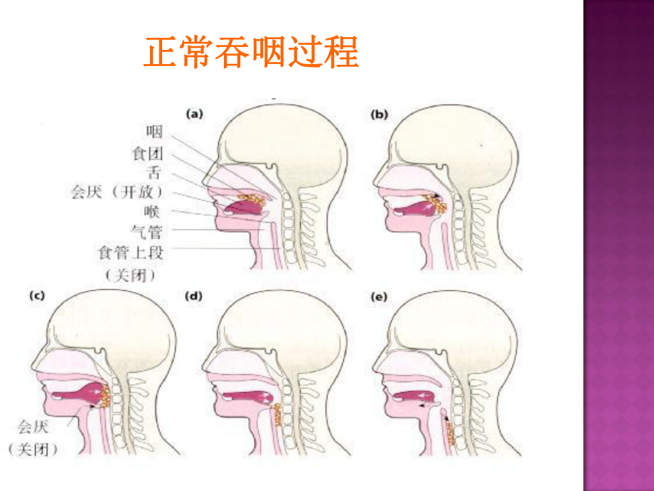 老年人住院期间误吸的预防和处理课件.ppt_第3页