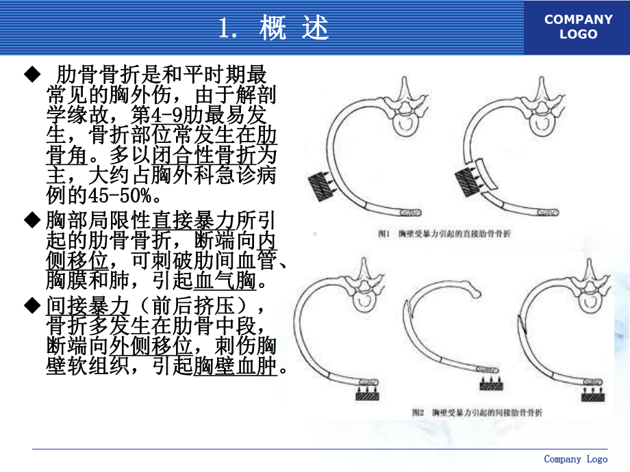 肋骨骨折的外科治疗课件.ppt_第3页