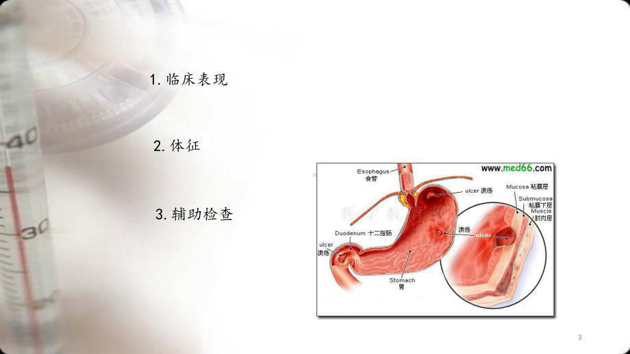 消化性溃疡的诊断与鉴别诊断课件.pptx_第3页