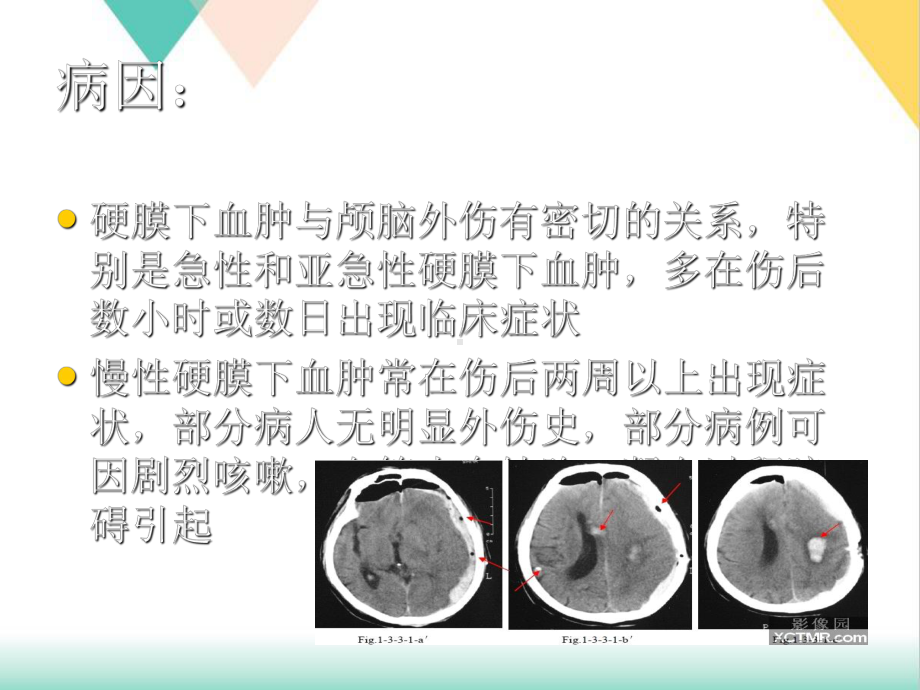 硬膜下血肿的护理查房课件.pptx_第3页