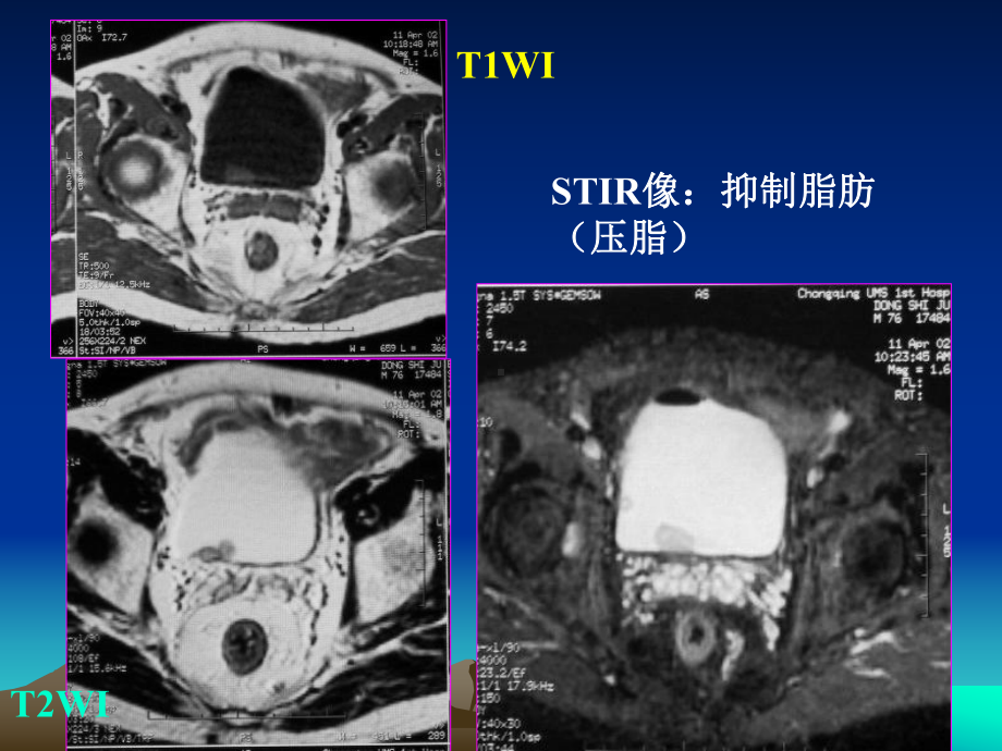 盆腔影像学诊断课件.ppt_第3页