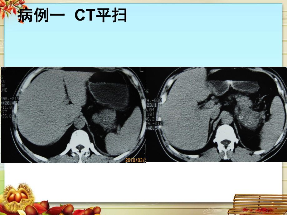 胰腺囊腺瘤影像诊断课件.pptx_第2页