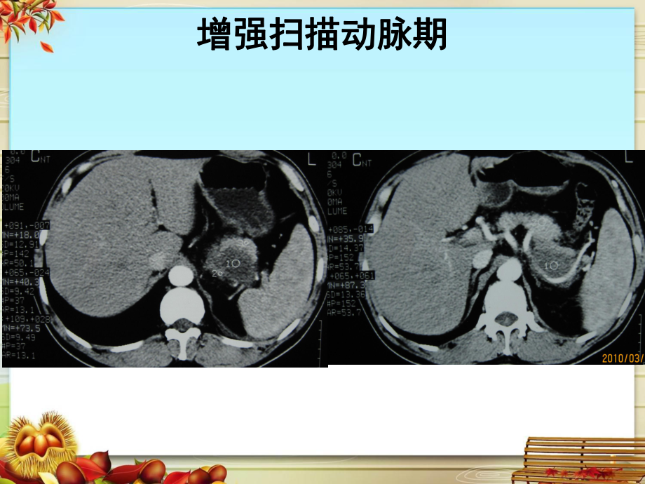 胰腺囊腺瘤影像诊断课件.pptx_第3页