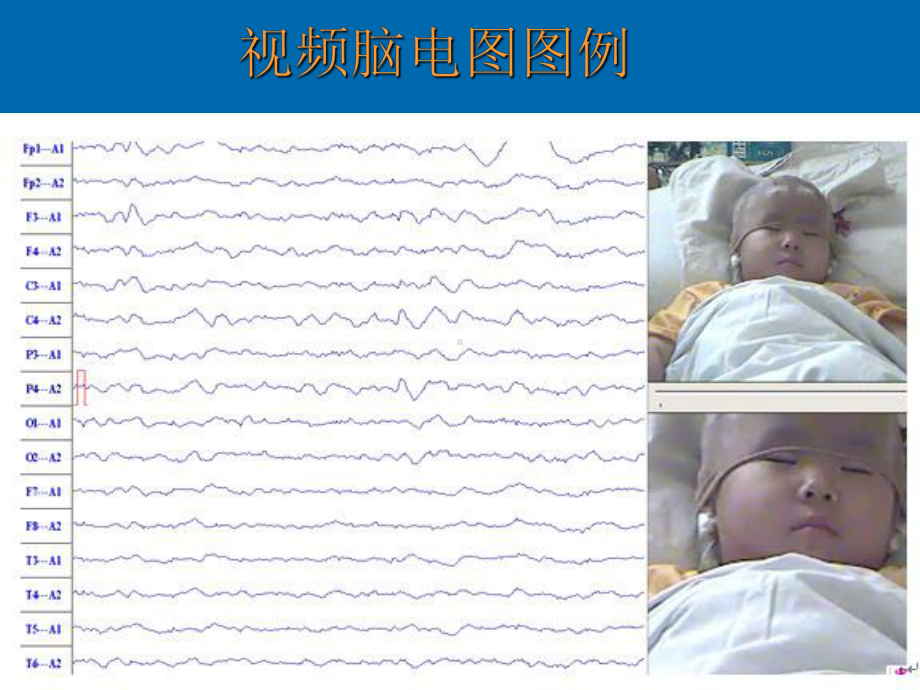 脑-电-图-基-础课件.pptx_第3页