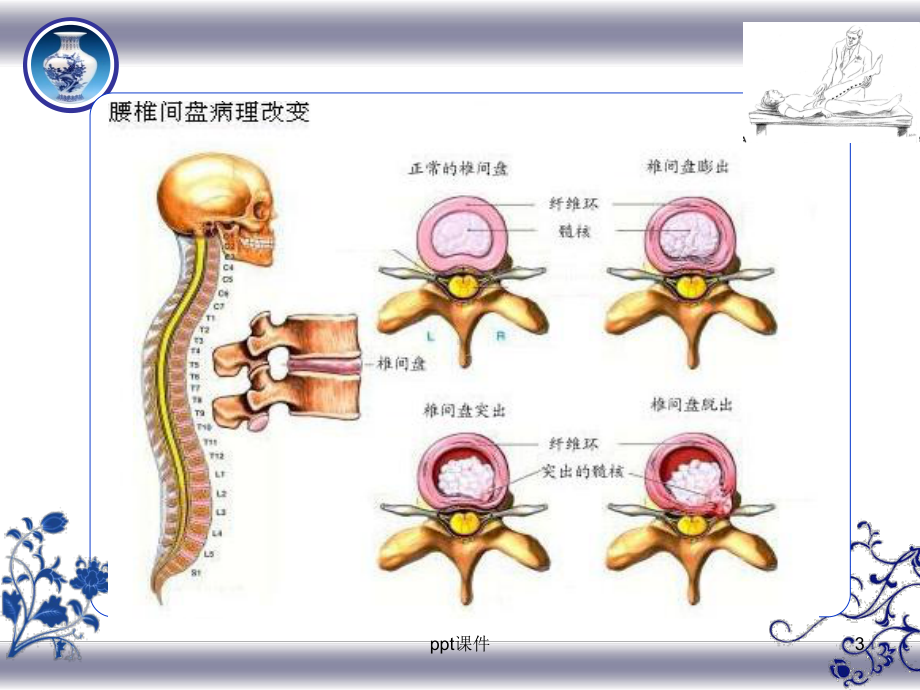 腰椎间盘突出症的中医护理-课件.ppt_第3页