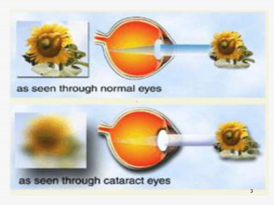 白内障术后并发症课件.ppt_第3页