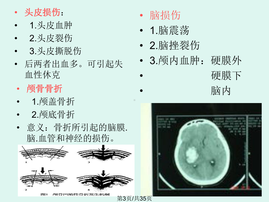 重型颅脑损伤教案课件.pptx_第3页