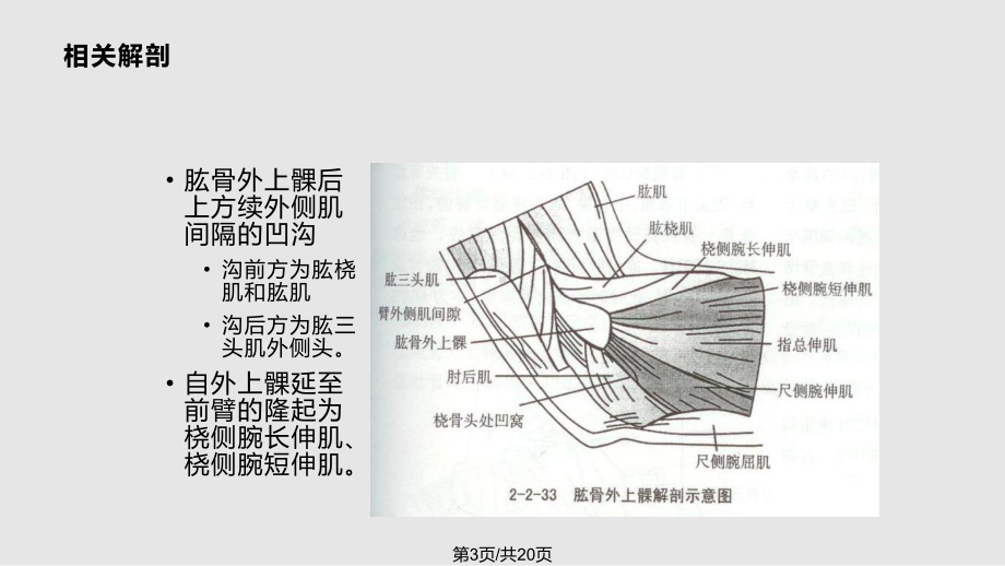 肱骨外上髁炎课件.pptx_第3页