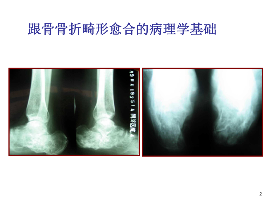 陈旧性跟骨骨折的手术治疗医学课件.ppt_第2页