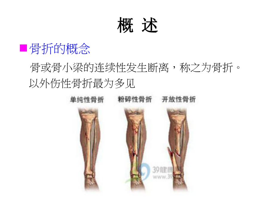 骨折後的康复治疗课件.ppt_第2页