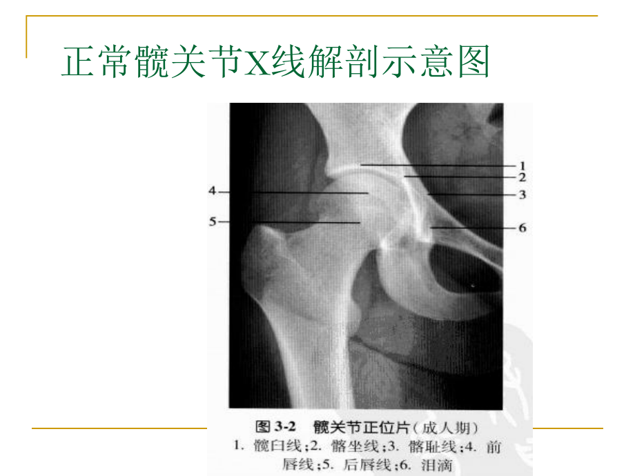 髋关节测量课件.pptx_第2页