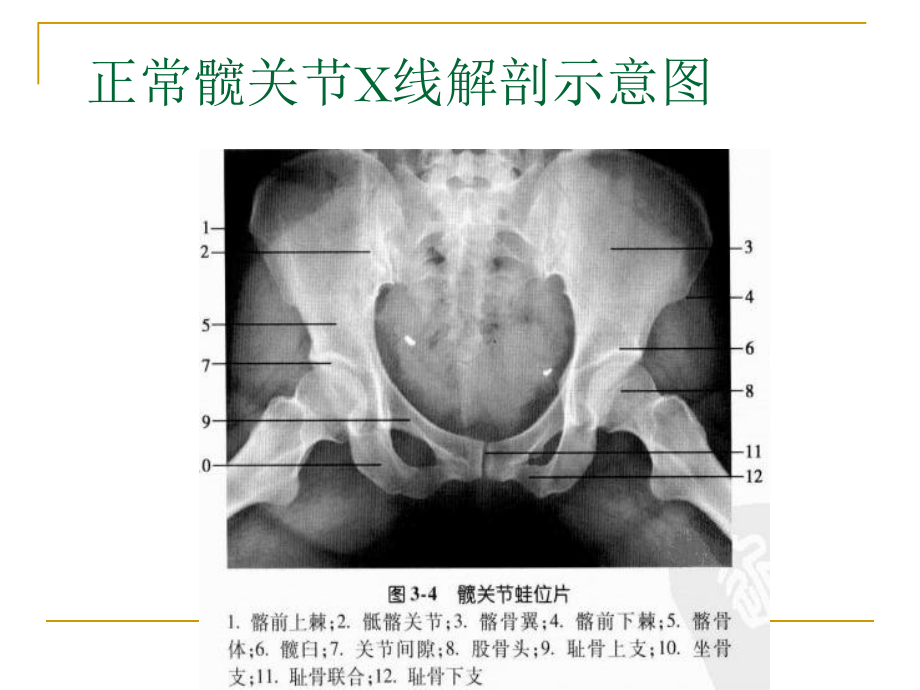 髋关节测量课件.pptx_第3页