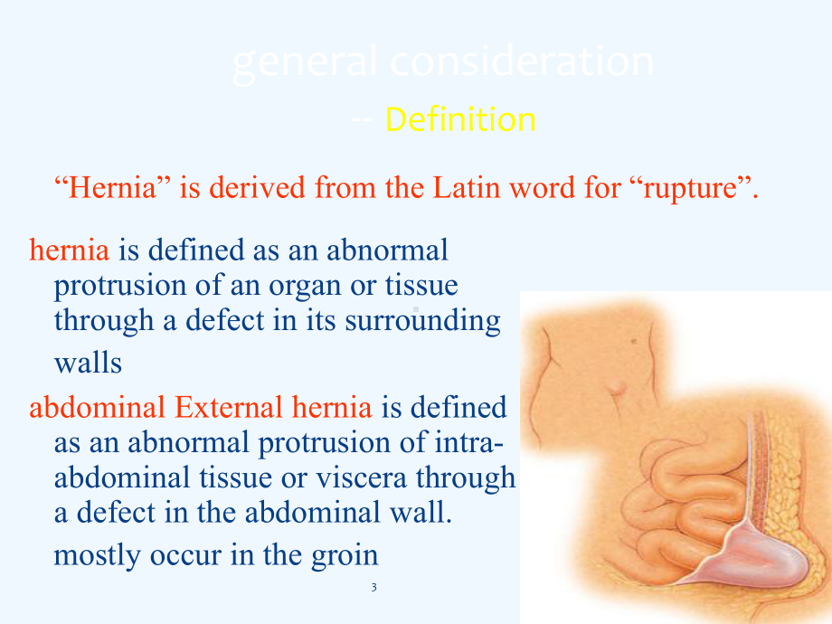 腹外疝课件ENGLISH.ppt_第3页