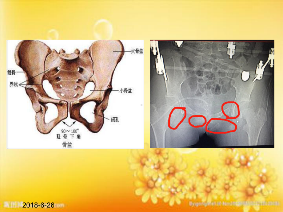 骨盆骨折外固定支架术后护理查房课件.ppt_第3页