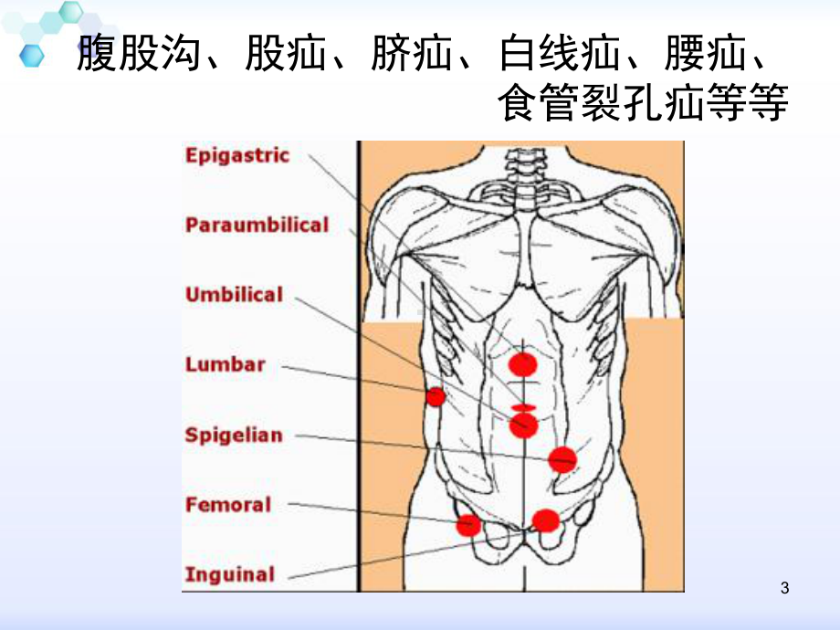 疝和腹壁外科进展课件.ppt_第3页