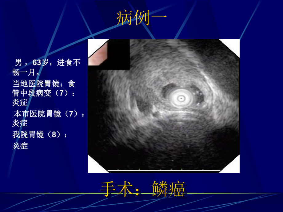 消化道隆起性病变的超声内镜诊断课件.ppt_第2页