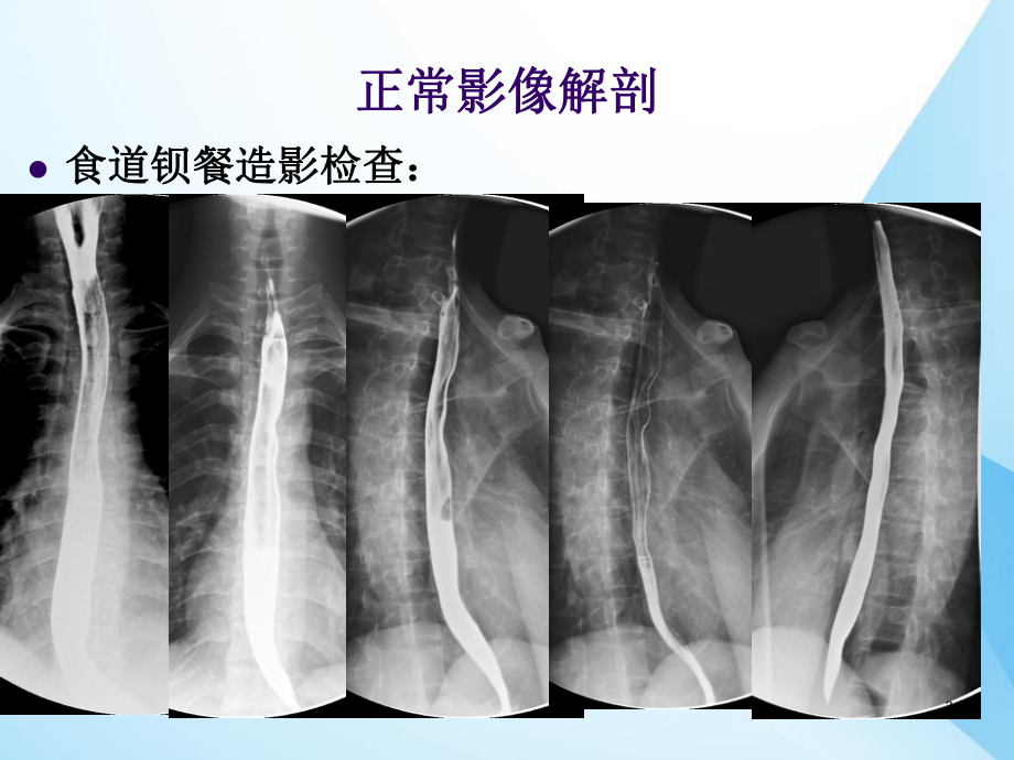 食道癌的影像学解读-课件.ppt_第3页