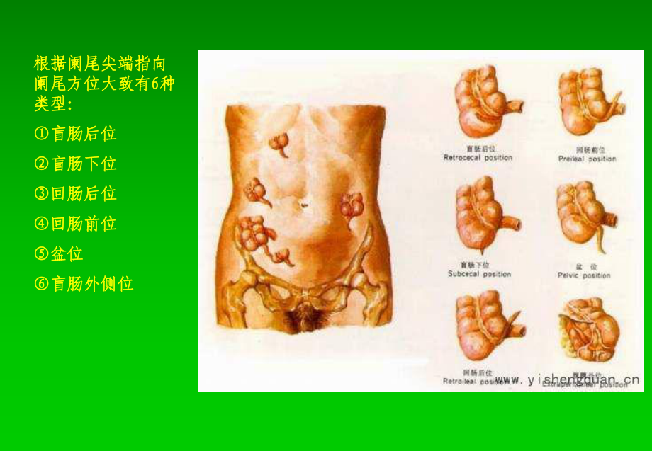 阑尾炎超声诊断汇编课件.ppt_第3页