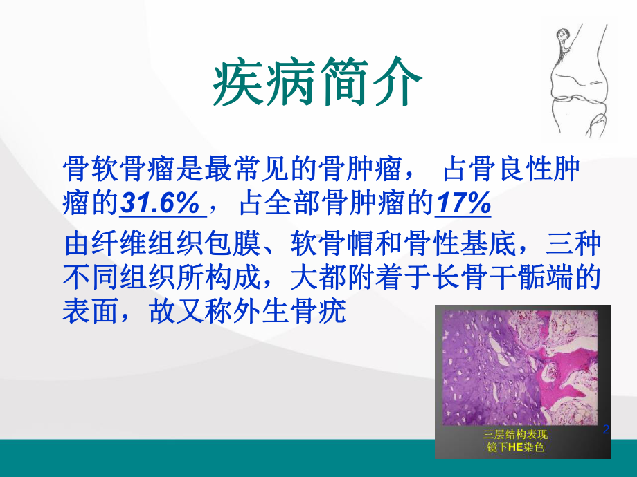 骨软骨瘤参考课件.ppt_第2页