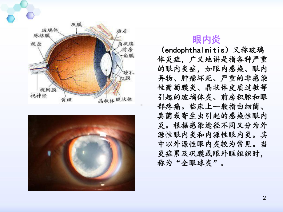 眼内炎患者的护理查房课件.ppt_第2页