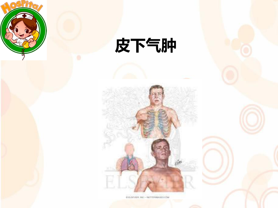 皮下气肿参考课件.ppt_第1页