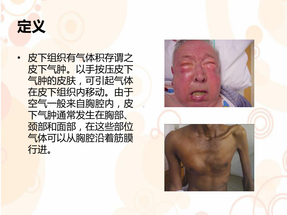 皮下气肿参考课件.ppt_第2页