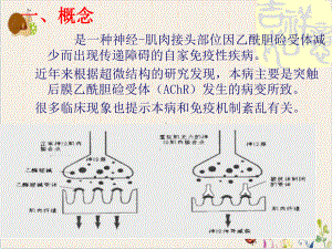 重症肌无力的护理课件.pptx