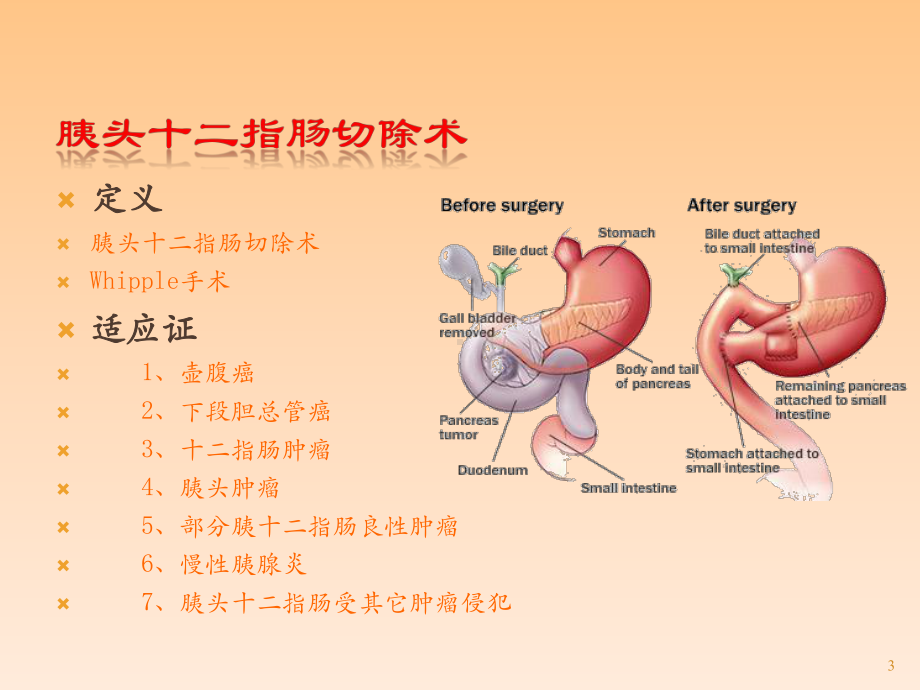 胰腺外科常用手术术式课件.pptx_第3页