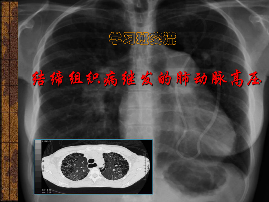 肺动高压课件.ppt_第1页