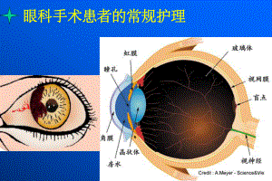 眼外伤及眼科手术护理-课件.ppt