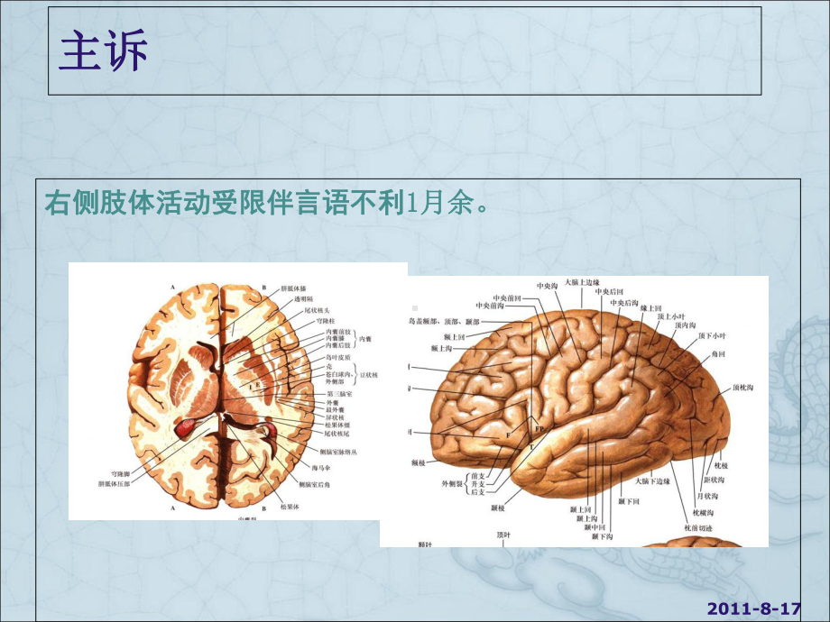 脑卒中康复病例汇报精选课件.pptx_第3页