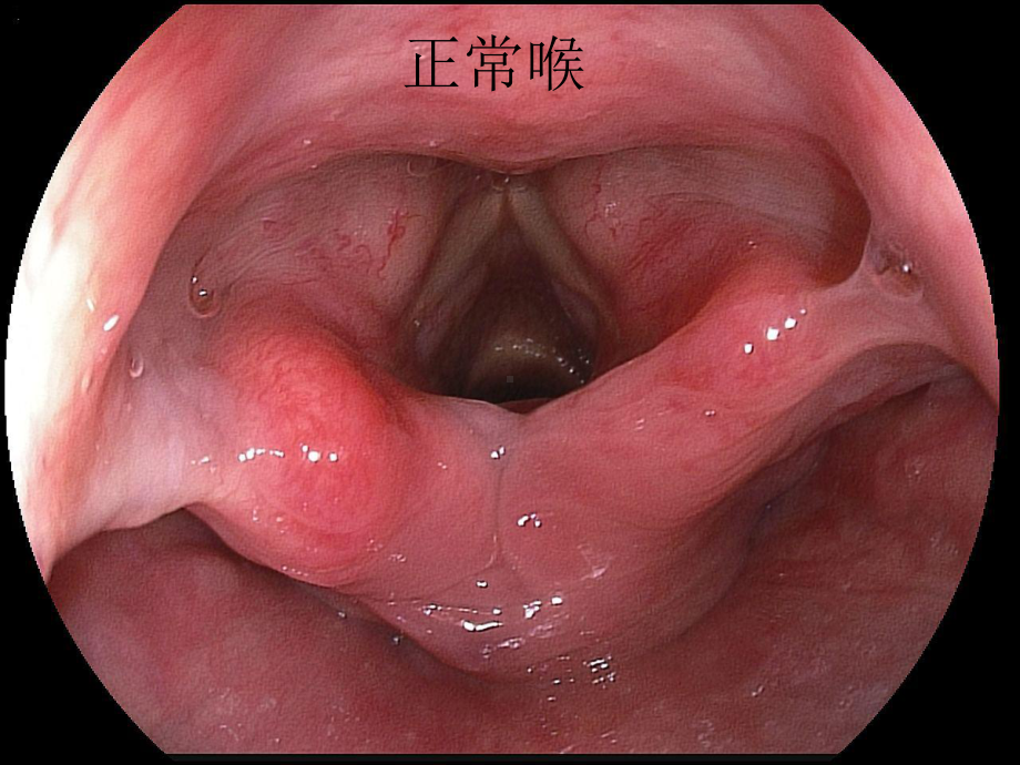 正常胃镜图片及常见病变(课堂)课件.ppt_第2页