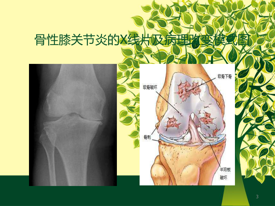 热敏灸治疗骨性膝关节炎课件.ppt_第3页