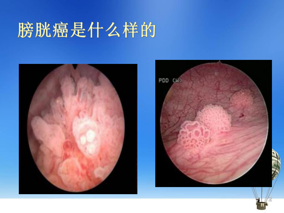 非肌层浸润性膀胱癌的诊断治疗课件.ppt_第2页