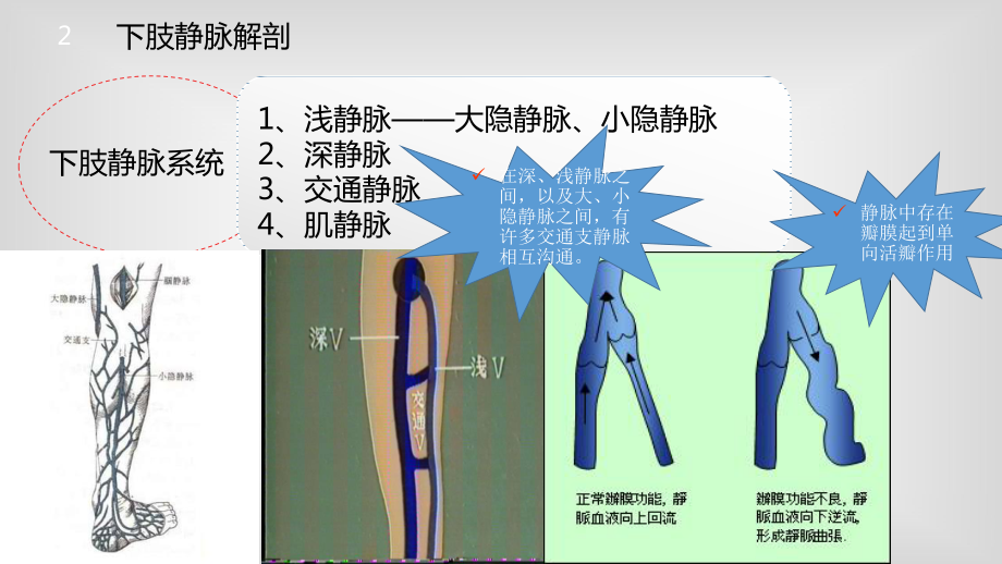 静脉曲张-课件.ppt_第3页