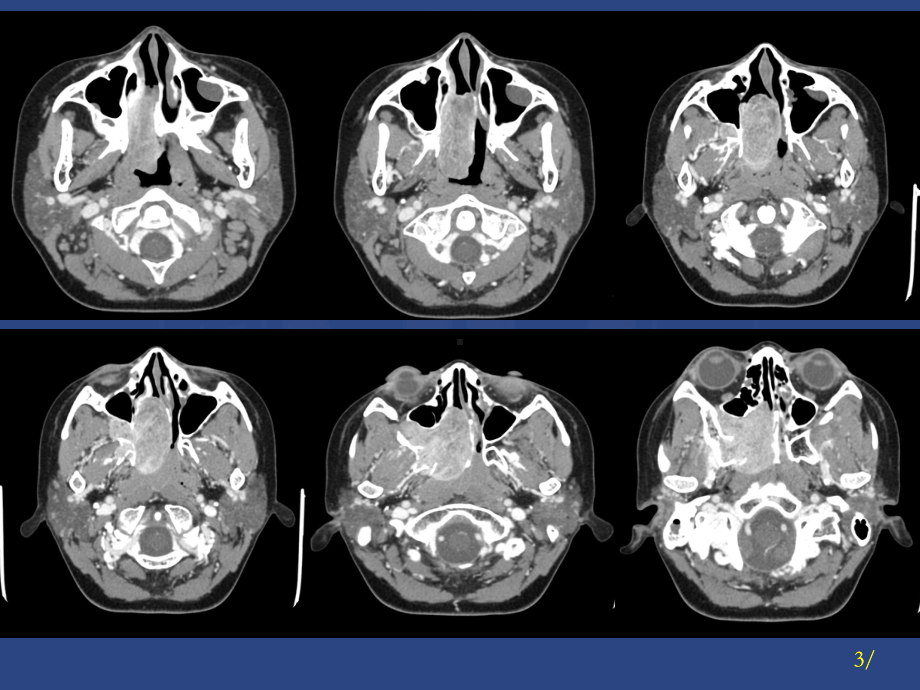 鼻咽纤维血管瘤课件.ppt_第3页