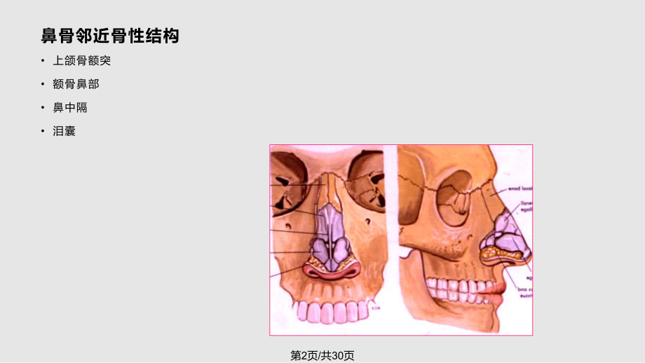 鼻骨骨折的影像诊断学习教案课件.pptx_第2页