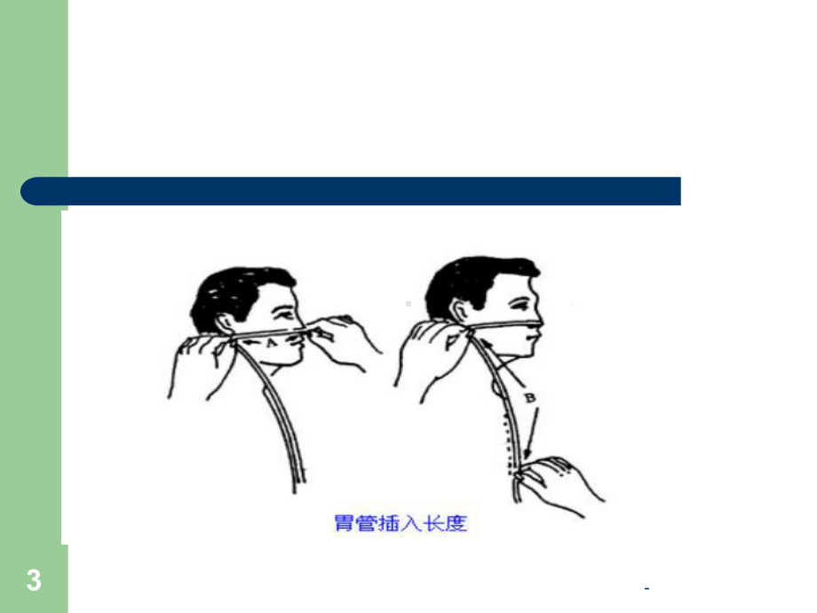 鼻饲操作注意事项及要领演示文稿-课件.ppt_第3页