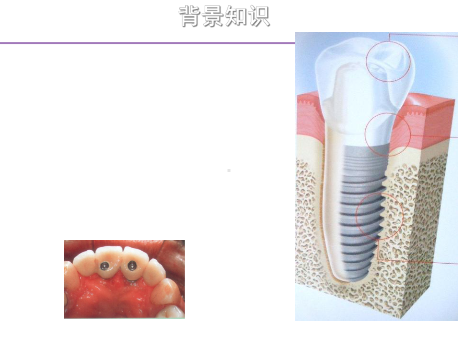 牙种植体颈部骨吸收和平台转换技术研究进展-精选课件.ppt_第3页