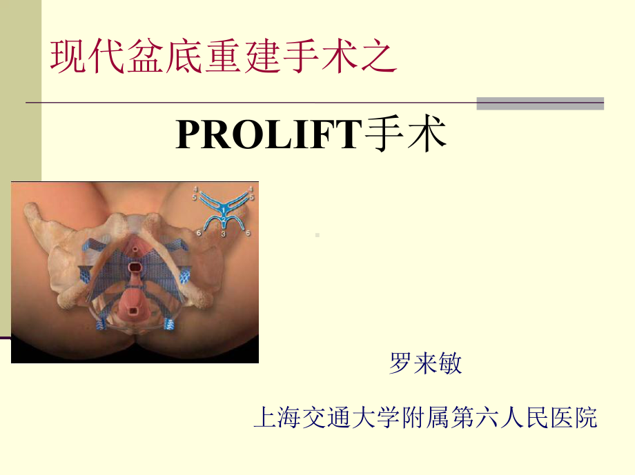 现代盆底重建手术之PROLIFT手术-妇产科课件.ppt_第1页